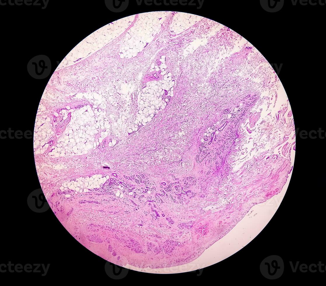 Photomicrograph, Prepatellar region histology showing Bursitis, acute or chronic Bursitis. photo