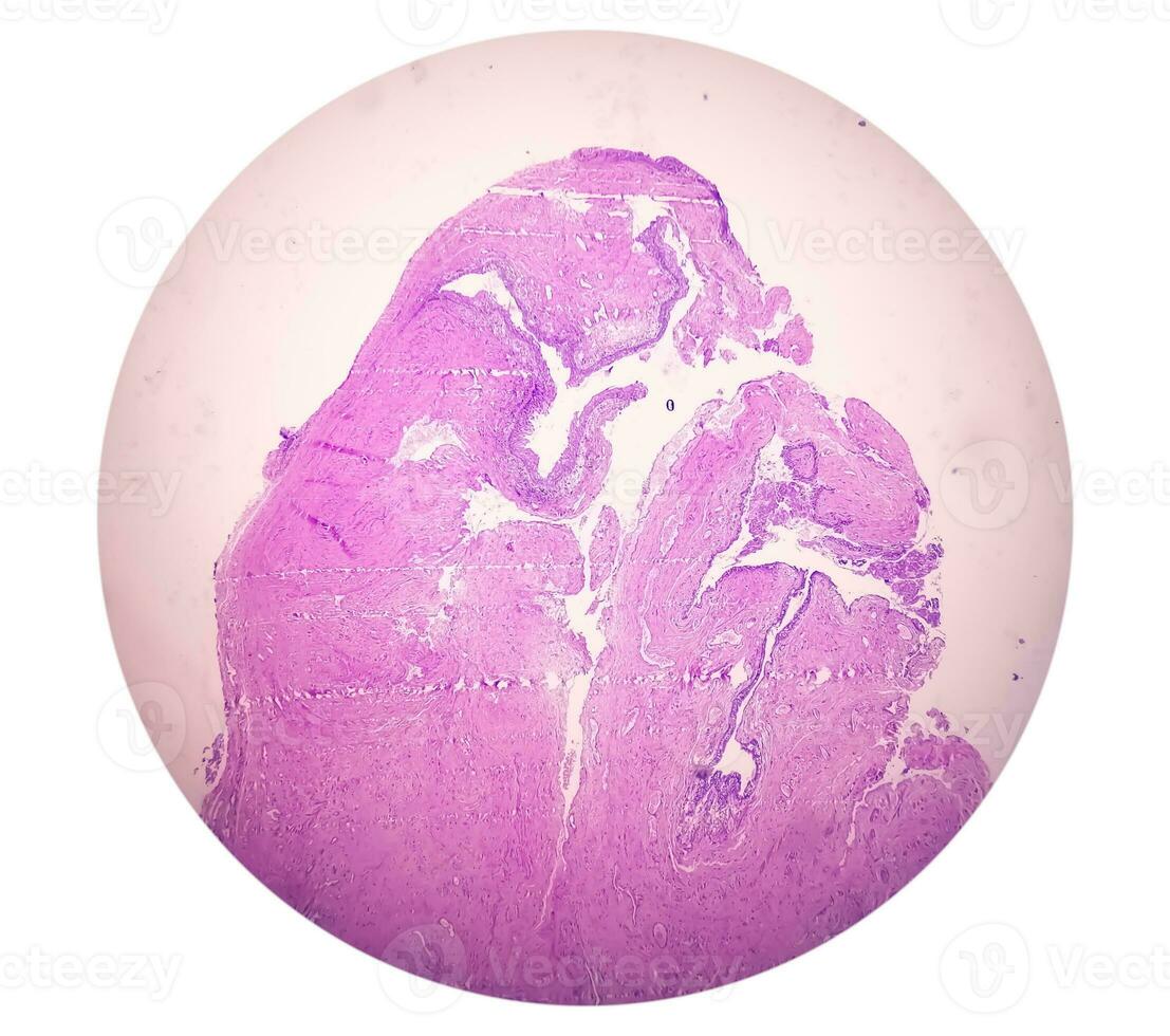 Histology of urachal cyst. Photomicrograph of histological stained slide showing Urachal cyst. Urethral cyst. photo