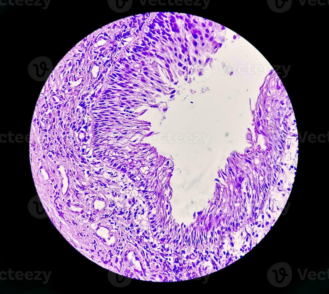 Histology of urachal cyst. Photomicrograph of histological stained slide showing Urachal cyst. Urethral cyst. photo