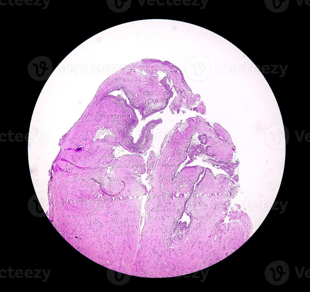 Histology of urachal cyst. Photomicrograph of histological stained slide showing Urachal cyst. Urethral cyst. photo