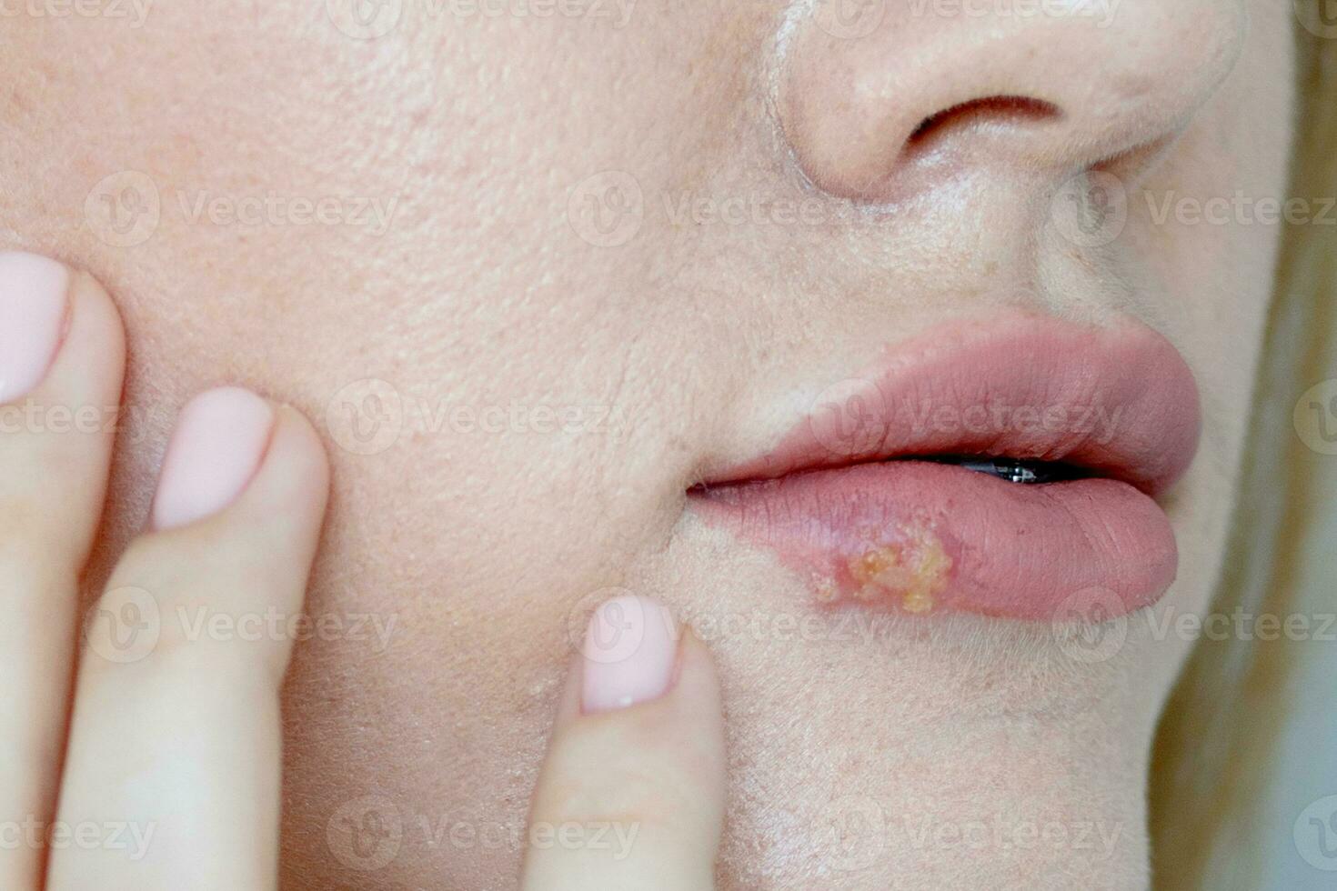 el mujer con un virus herpes en labios foto