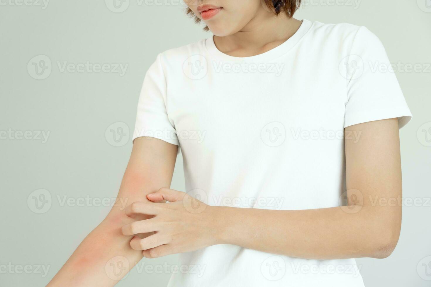 skin problem and beauty. Young woman scratch body has itchy skin from skin allergic, steroid allergy, sensitive skin, red from sunburn, chemical allergy, rash, insect bites, Seborrheic Dermatitis. photo