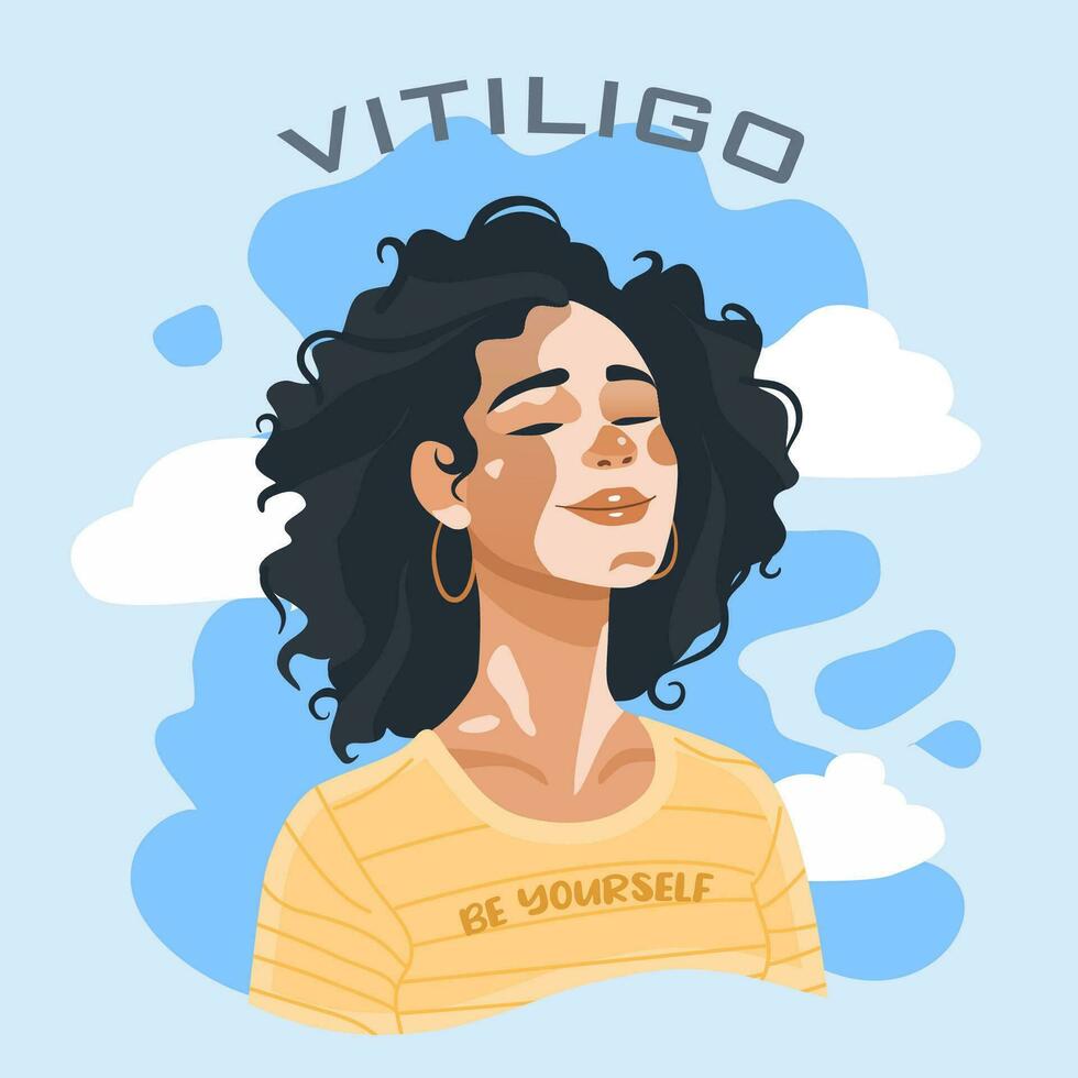 Happy woman with Vitiligo skin problems. World Vitiligo Day vector