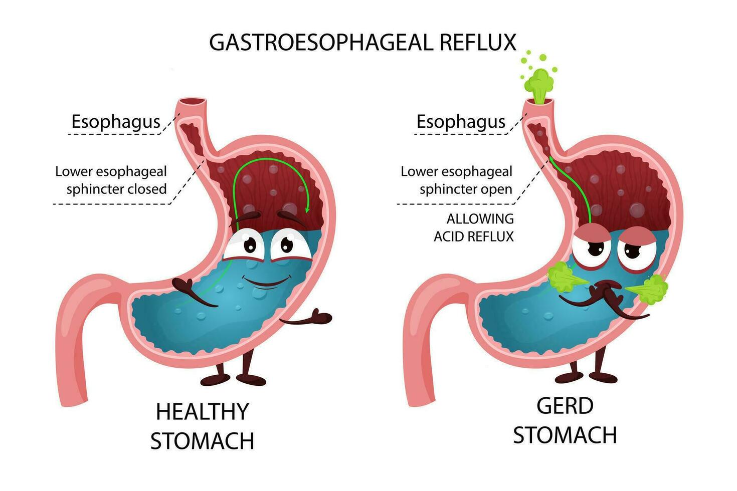 Happy healthy stomach and sick GERD cartoon stomach characters 34331738