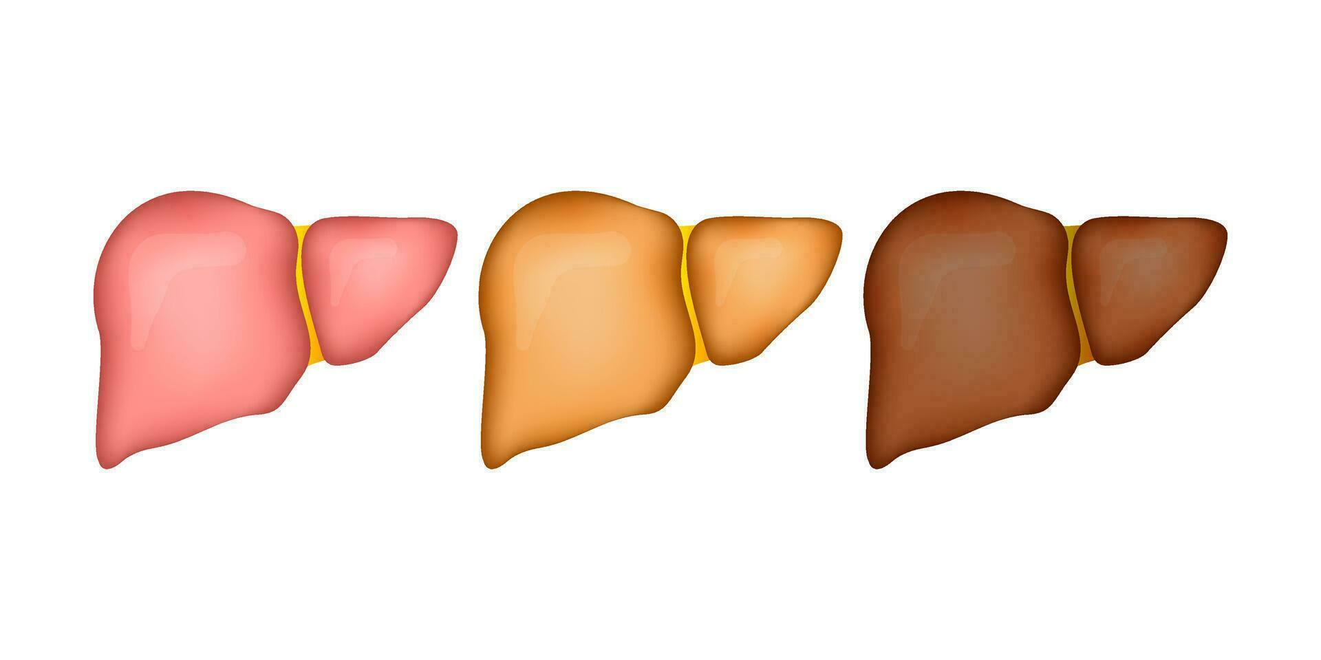 Human liver. Stages human liver damage. Vector stock illustration.