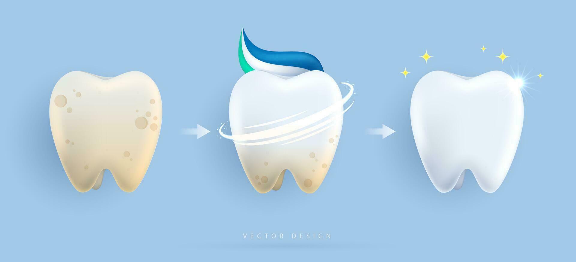 conjunto de dental limpieza y blanqueo dientes concepto. comparación de limpiar y sucio diente. dental salud y oral higiene póster para odontología. examen dientes, blanqueo y reparar. vector diseño.