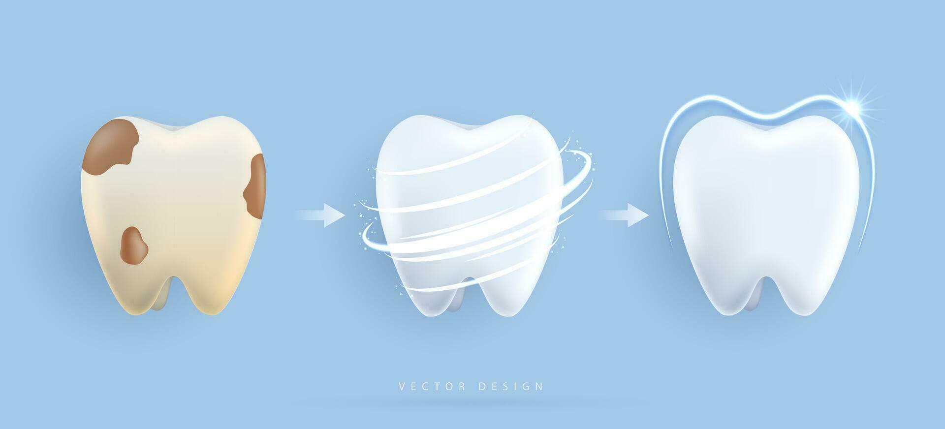 conjunto de dental limpieza y blanqueo dientes concepto. comparación de limpiar y sucio diente. dental salud y oral higiene póster para odontología. examen dientes, blanqueo y reparar. vector diseño.