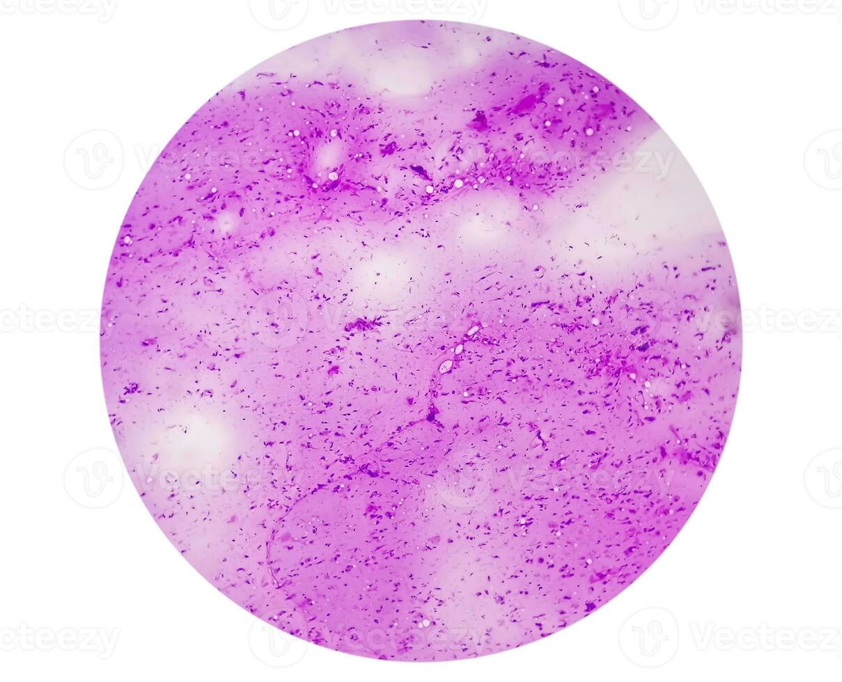 Photomicrograph showing Neurofibroma. Neurofibromatosis, is a genetic disorder, gene mutations. photo