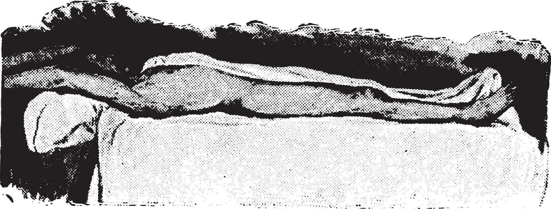 Wet sheet pack, patient partly covered, vintage engraving. 34500937