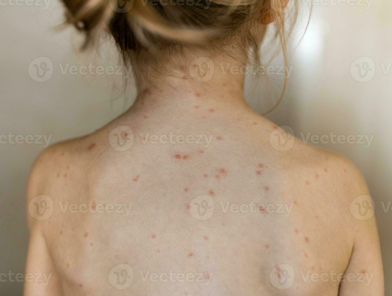 espalda de pequeño niña con varicela, varicela virus o vesicular erupción foto