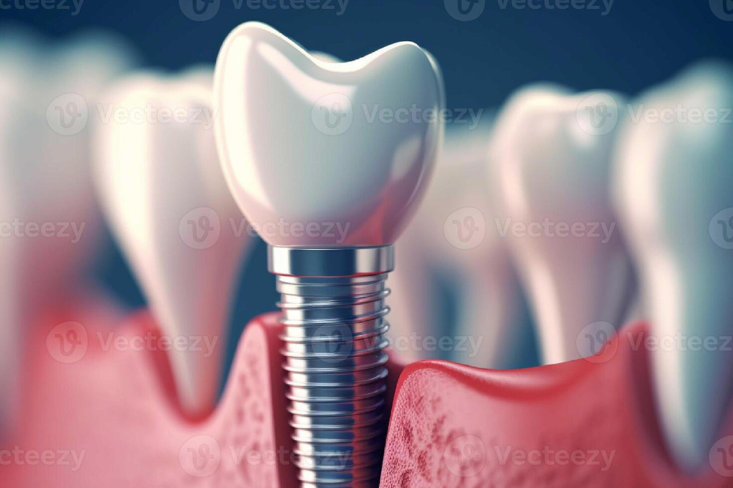 A tooth implant in a black background generated with AI photo