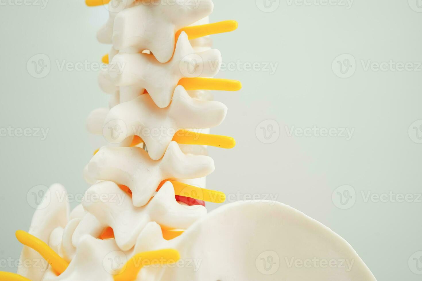 Spinal nerve and bone, Lumbar spine displaced herniated disc fragment, Model for treatment medical in the orthopedic department. photo