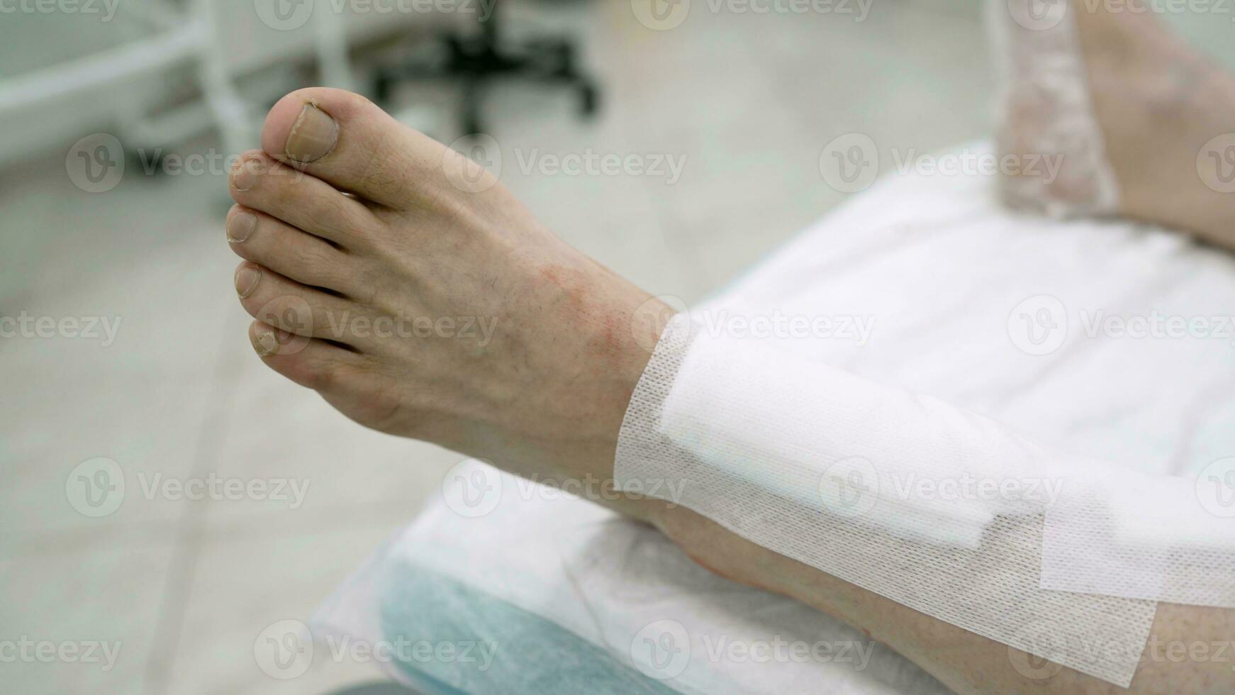 Legs in a bandage on a hospital bed. Operation on the veins of the legs. The doctor puts a bandage on the man's leg. Preparing the patient for phlebectomy surgery. Problems with superficial veins. photo