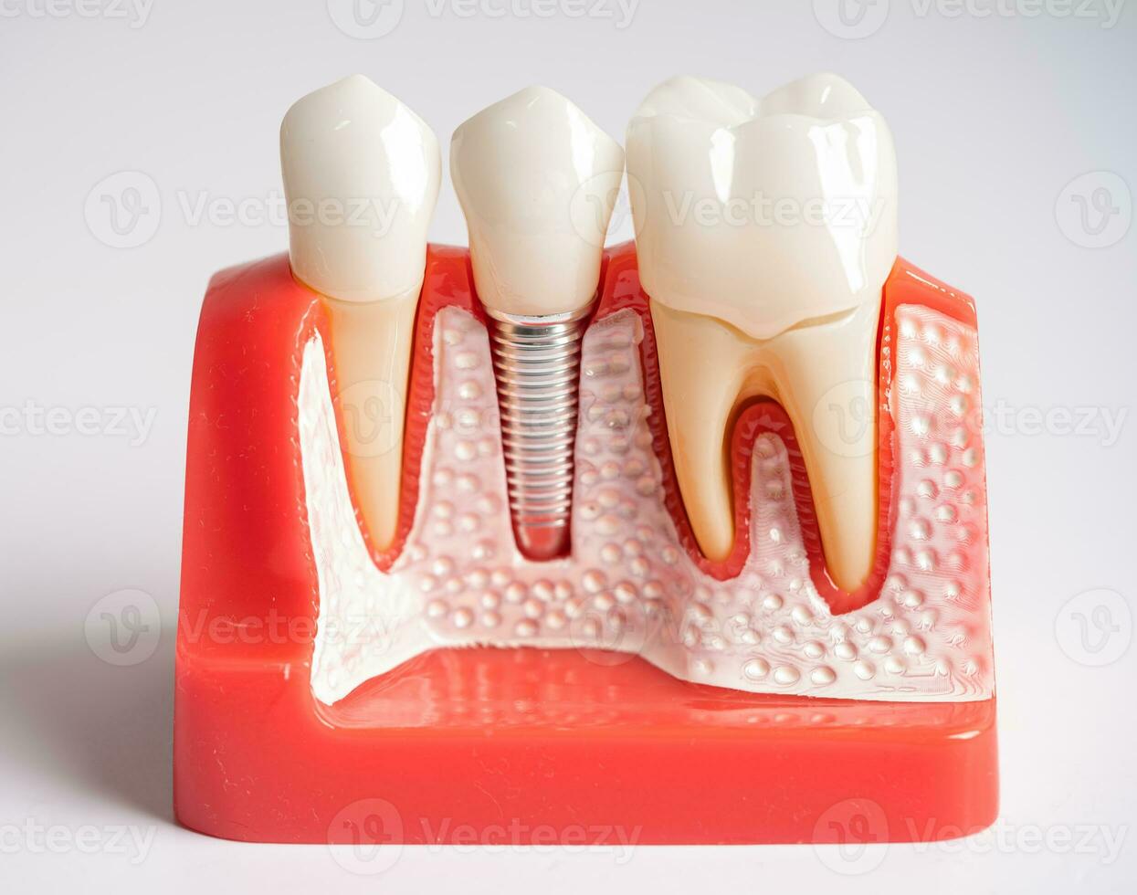 Dental implant, artificial tooth roots into jaw, root canal of dental treatment, gum disease, teeth model for dentist studying about dentistry. photo