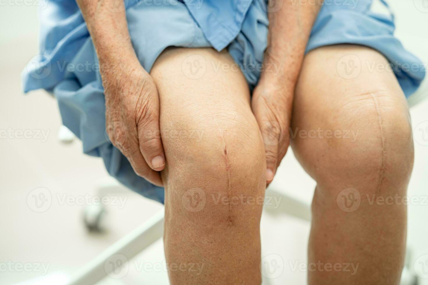 Asian elderly woman patient show her scars surgical total knee joint replacement Suture wound surgery arthroplasty on bed in hospital. photo