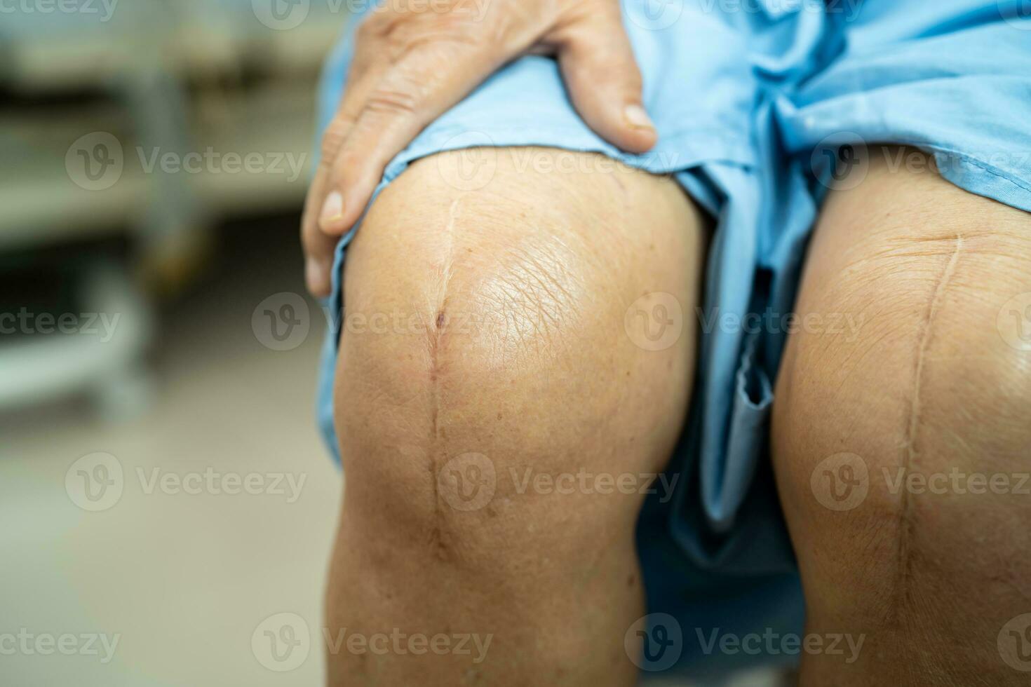 asiático mayor mujer paciente espectáculo su cicatrices quirúrgico total rodilla articulación reemplazo sutura herida cirugía artroplastia en cama en hospital. foto