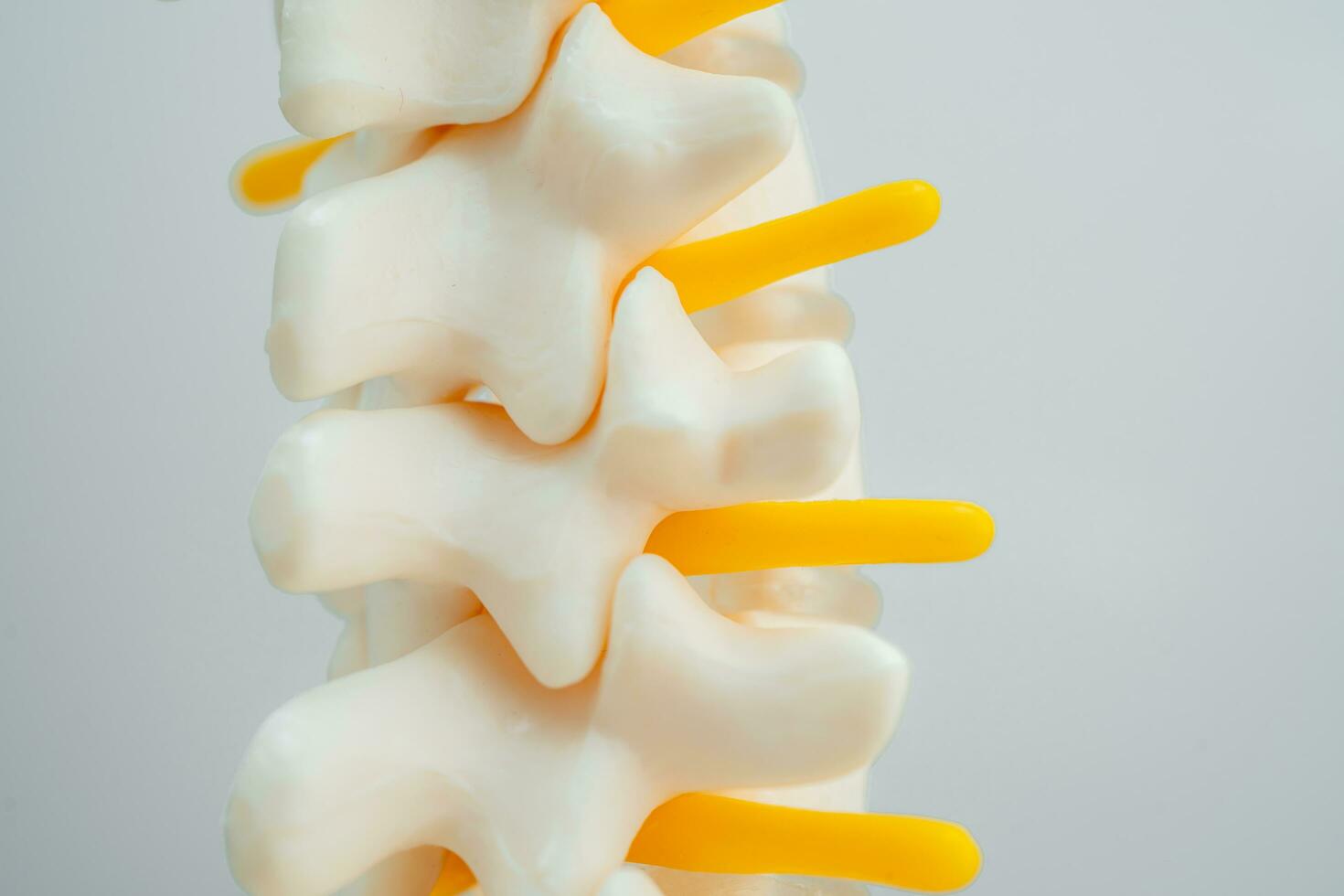 Lumbar spine displaced herniated disc fragment, spinal nerve and bone. Model for treatment medical in the orthopedic department. photo