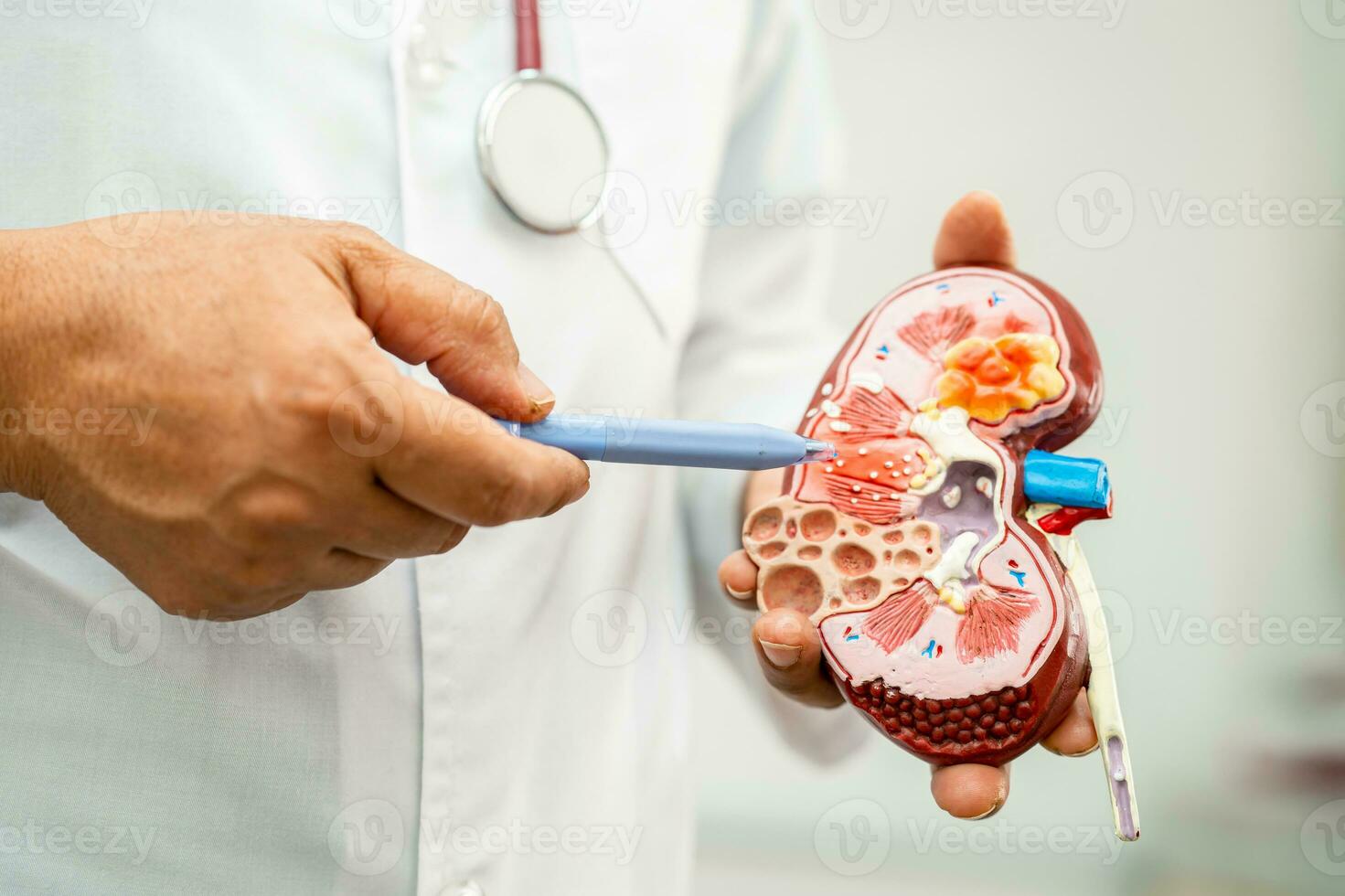 Kidney disease, Chronic kidney disease ckd, Doctor hold model to study and treat in hospital. photo