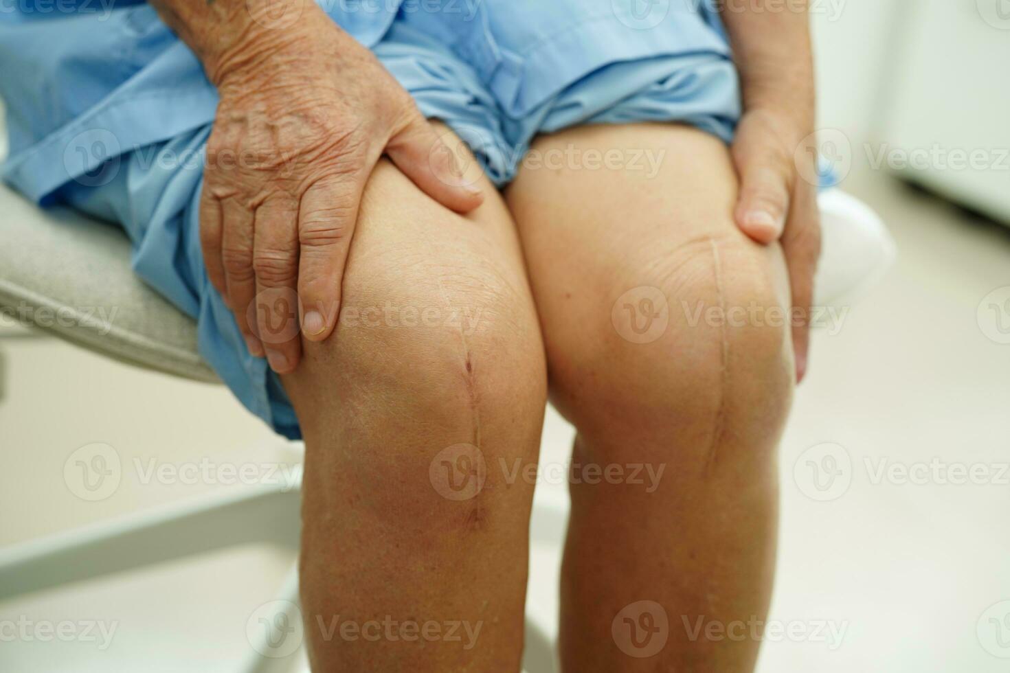 Asian elderly woman patient with scar knee replacement surgery in hospital. photo