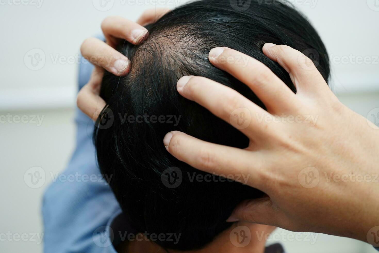 Bald head in man, hair loss treatment health problem. photo