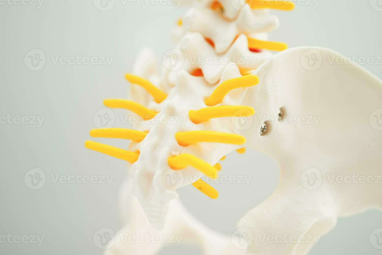 Spinal nerve and bone, Lumbar spine displaced herniated disc fragment, Model for treatment medical in the orthopedic department. photo