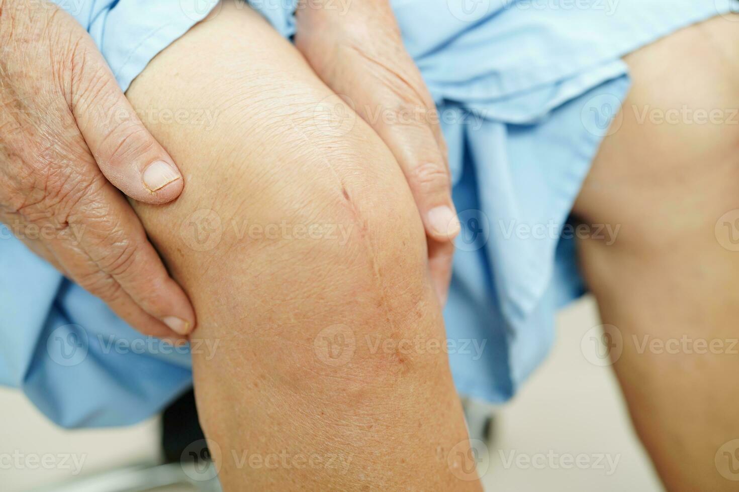 Asian elderly woman patient with scar knee replacement surgery in hospital. photo