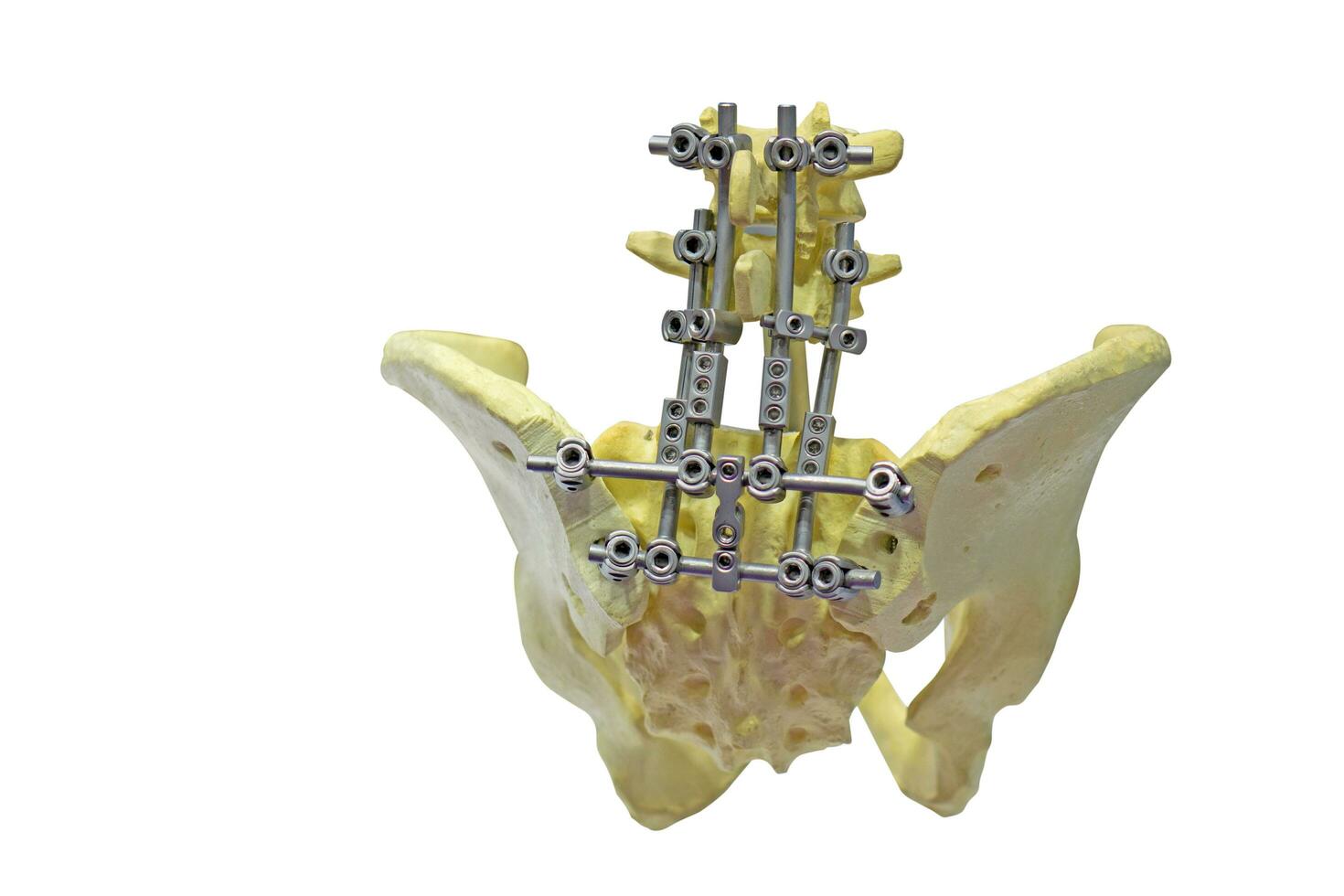 Repair of the pelvis or hip joint using an iron splint. photo