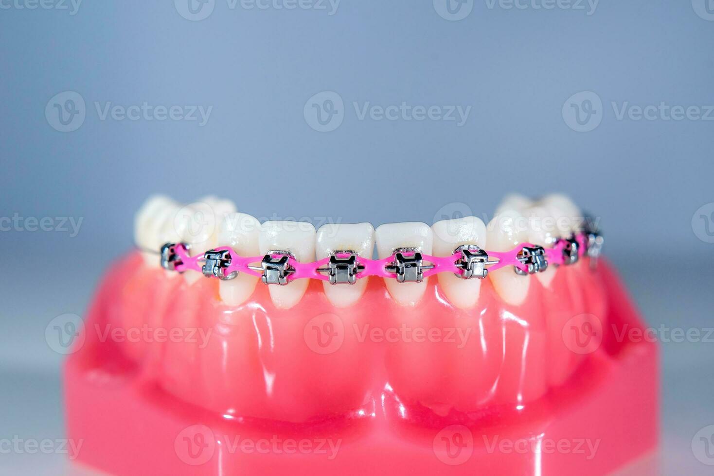 Braces are placed on the teeth in the artificial jaw against a light blue background. Macro photography photo