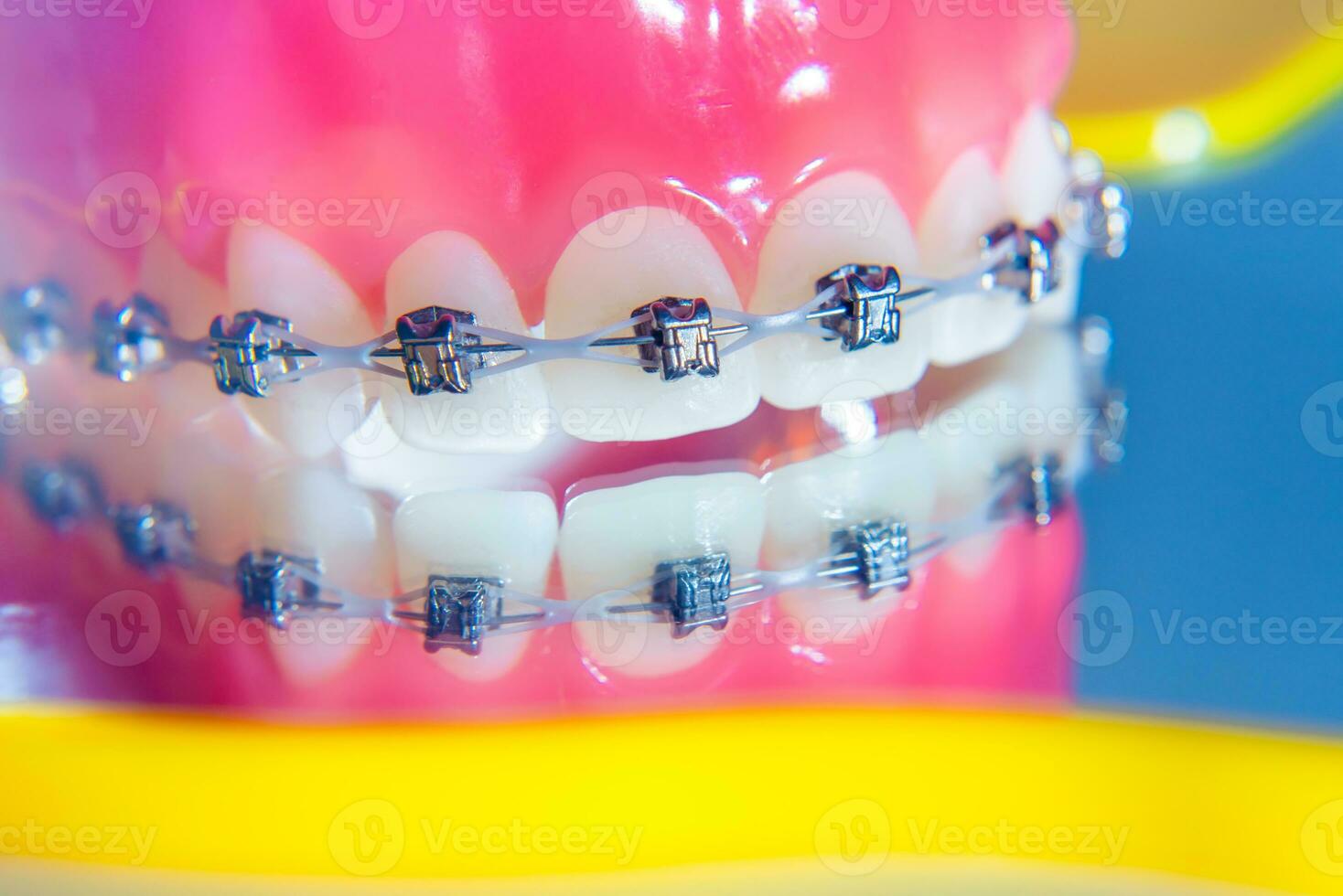 The braces are placed on the teeth in the artificial jaw. Macro photography photo