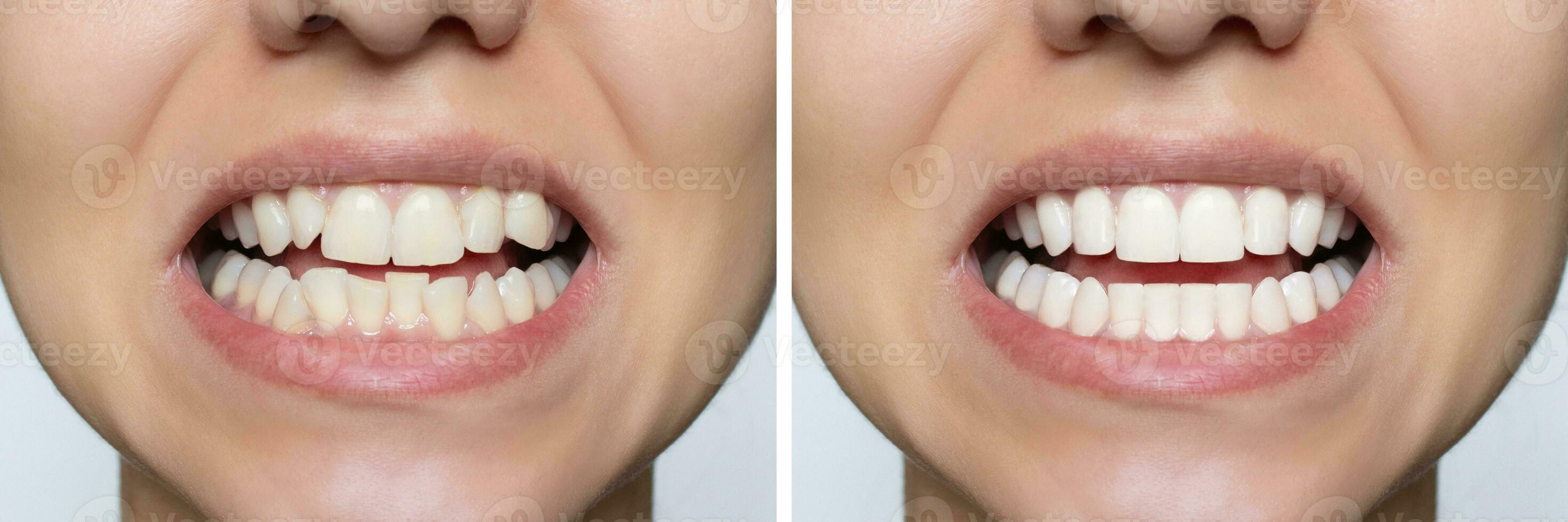 Young woman's smile before and after teeth straightening. Ideal, beautiful shape of teeth on the upper and lower jaw after installing veneers or braces. Bleaching. Dental clinic patient. photo
