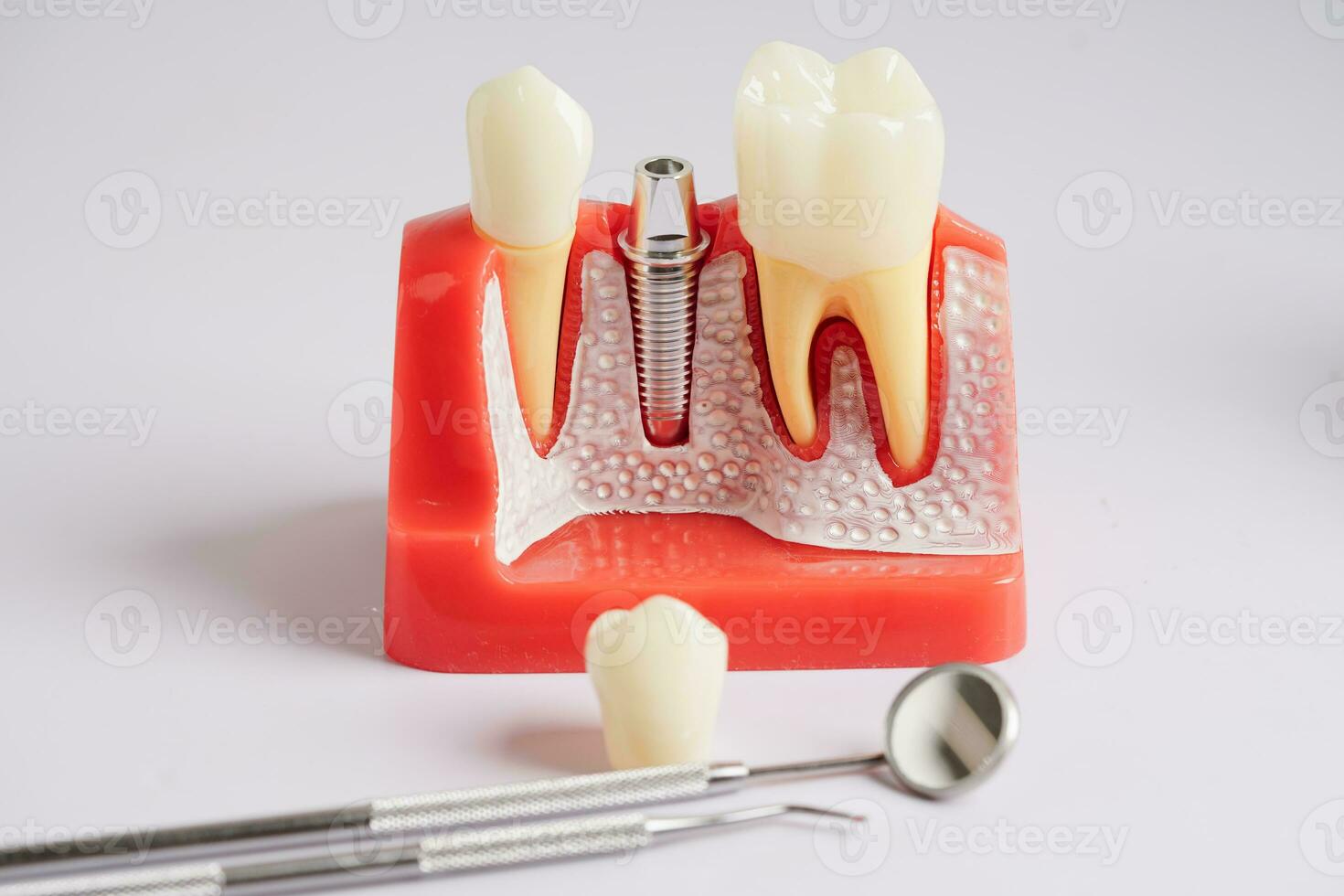 Dental implant, artificial tooth roots into jaw, root canal of dental treatment, gum disease, teeth model for dentist studying about dentistry. photo