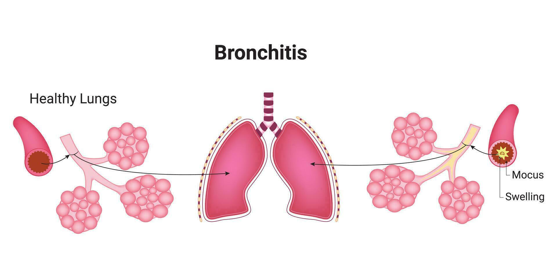 bronquitis Ciencias diseño vector ilustración diagrama