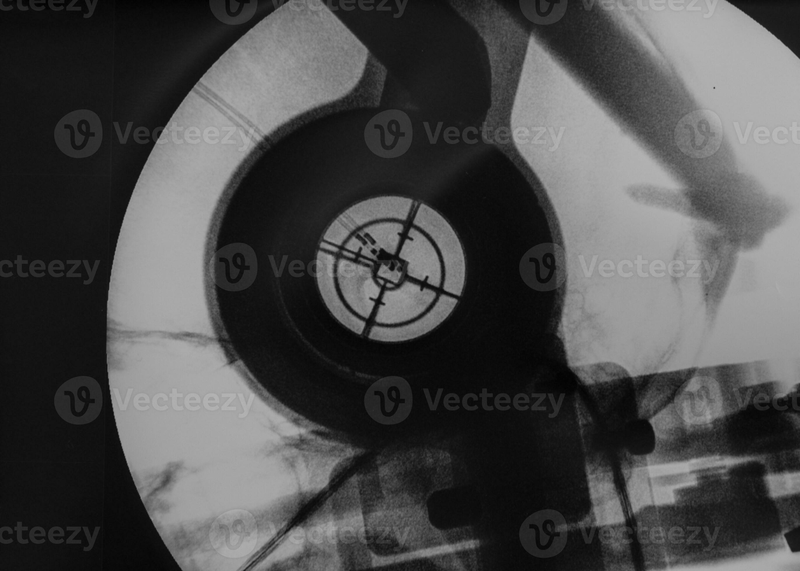 Intraoperative fluoroscopy of electrodes during Parkinson surgery