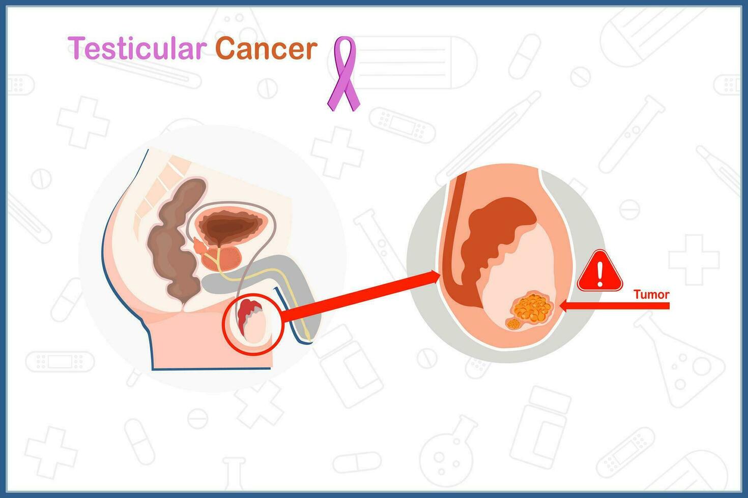 Flat medical vector in testicular cancer concept. A Male Anatomy of Testicular Cancer illustration isolated on white background.