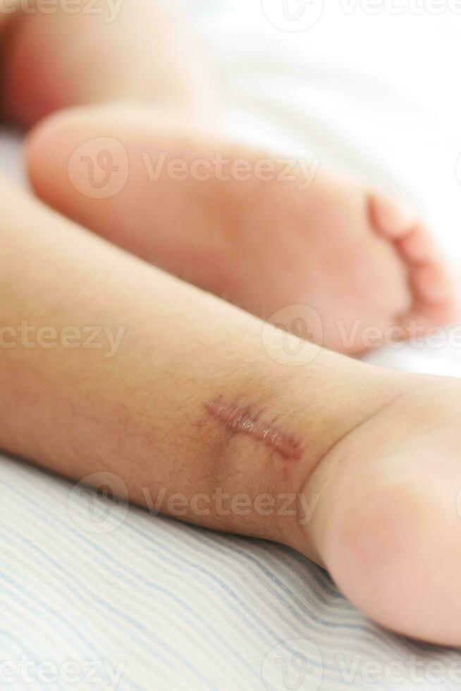 cosido herida marca en un niño pie. foto