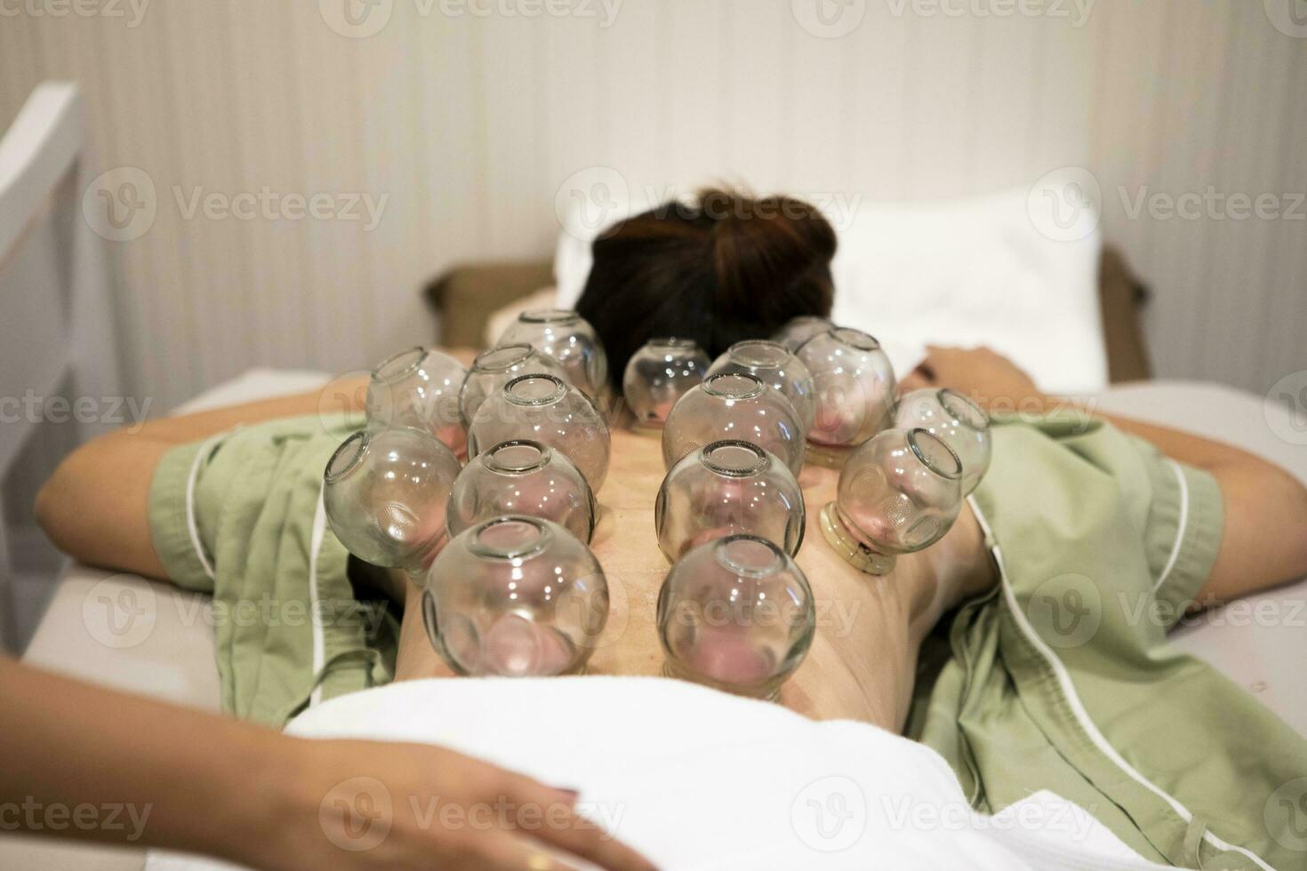 cupping treatment on woman back alternative healthy medical treatment photo
