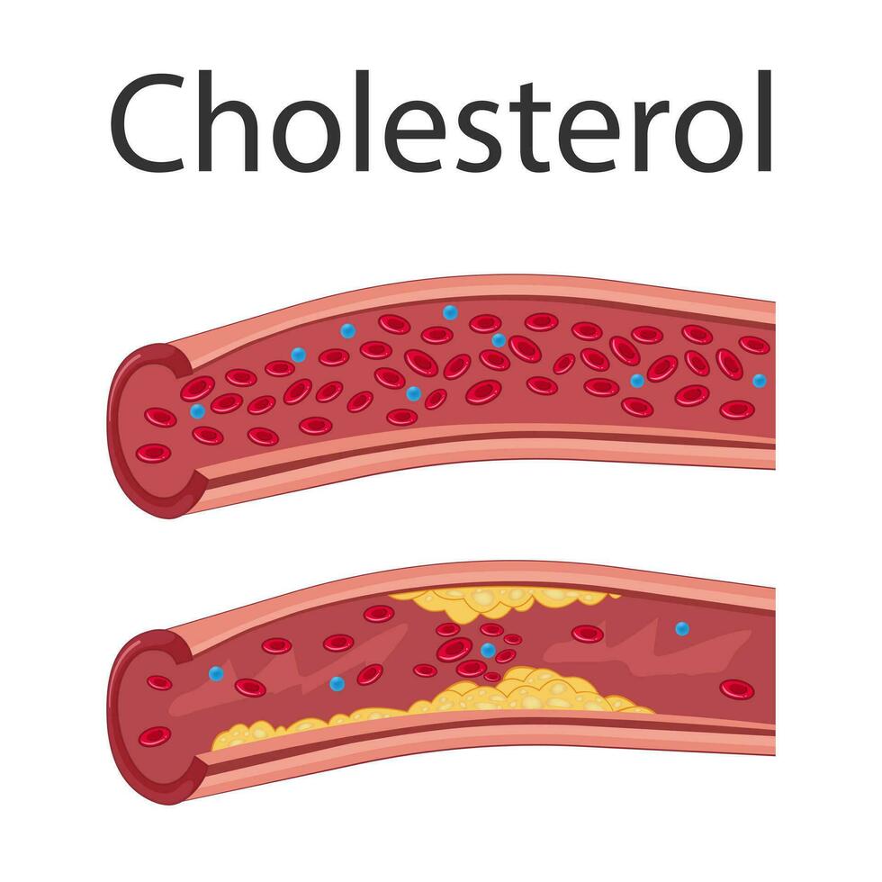 Atherosclerosis concept. enlarged artery with plaques. Medical vector illustration