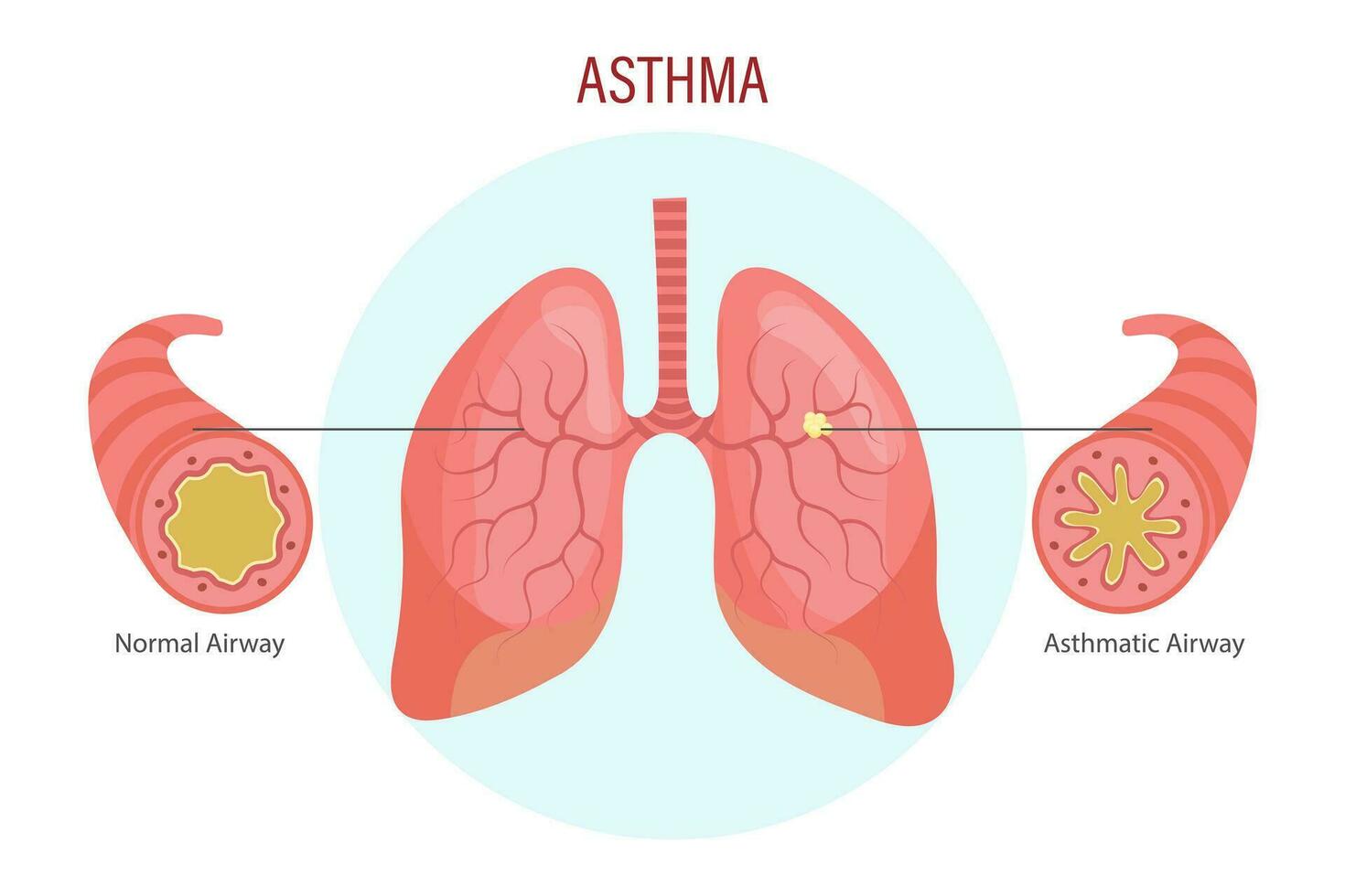 asma, pulmón enfermedad. médico infografía bandera, ilustración, vector