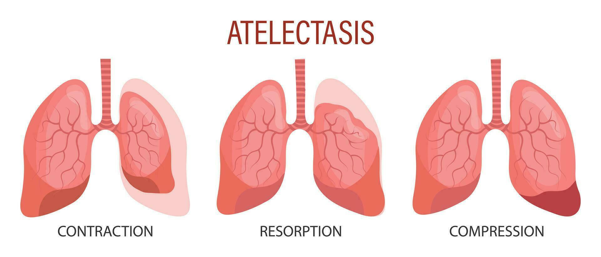 atelectasia, un pulmón enfermedad. contracción, reabsorción, compresión. médico infografía bandera, ilustración, vector