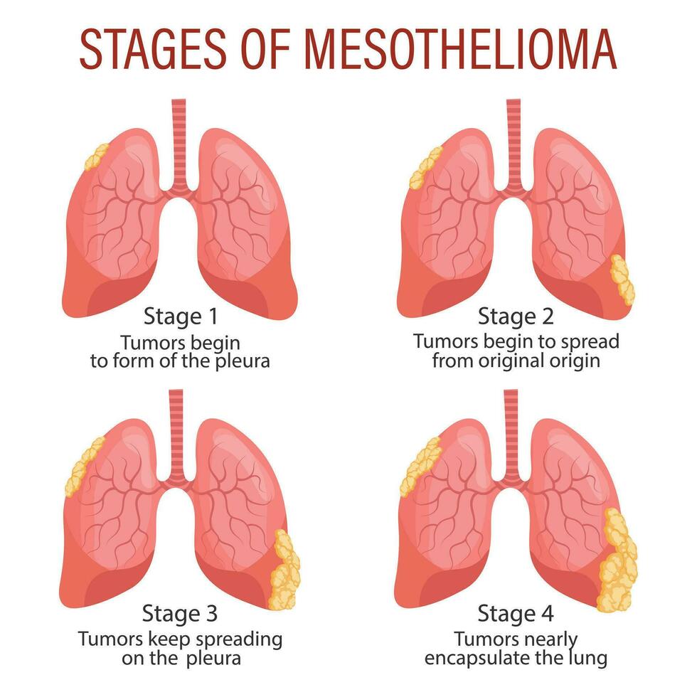 etapas de mesotelioma, pulmón enfermedad. cuidado de la salud. médico infografía bandera, ilustración, vector