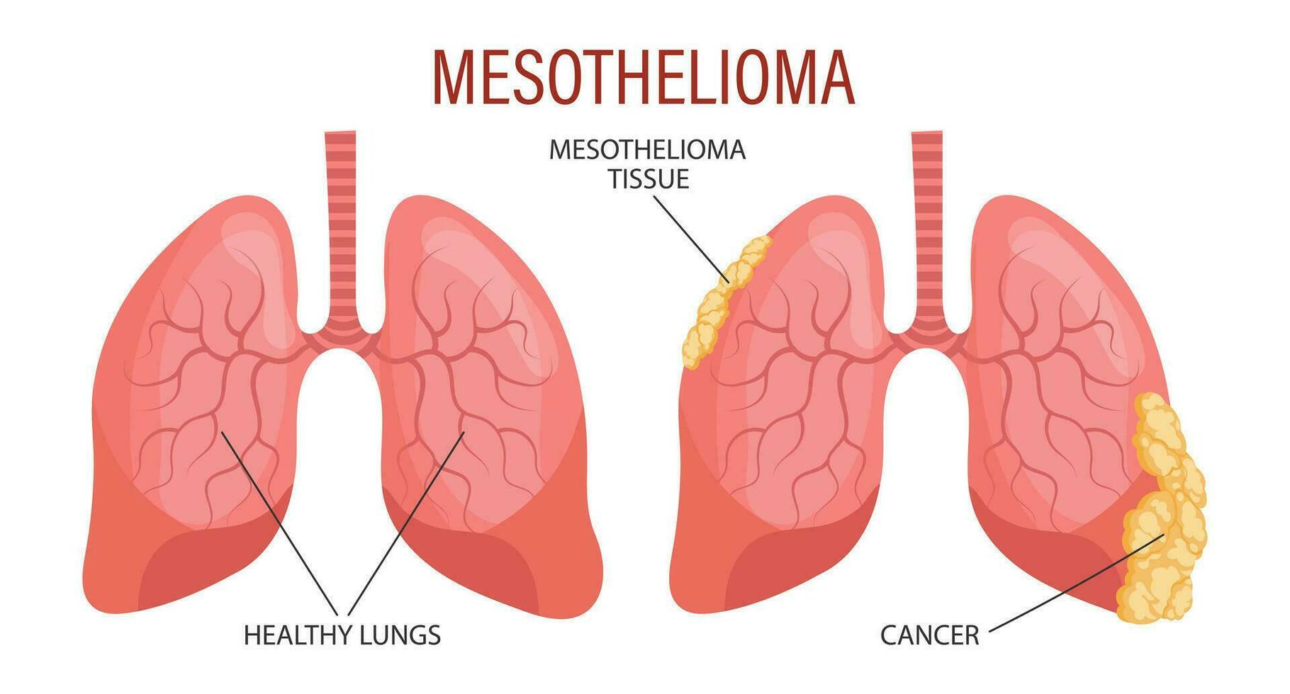 etapas de mesotelioma, pulmón enfermedad. cuidado de la salud. médico infografía bandera, ilustración, vector