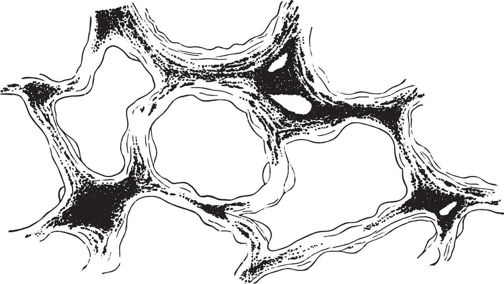 Section of lung showing infiltration of the connective tissue of the alveolar wall by coal-dust Anthracosis, vintage engraving. vector