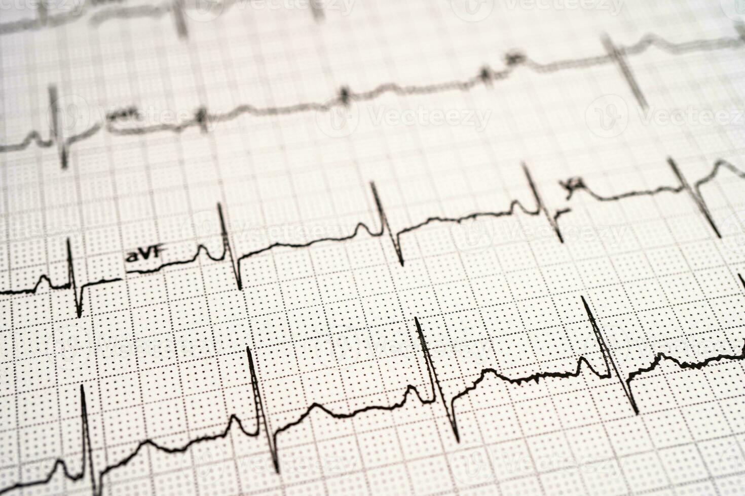 Electrocardiogram ECG, heart wave, heart attack, cardiogram report. photo
