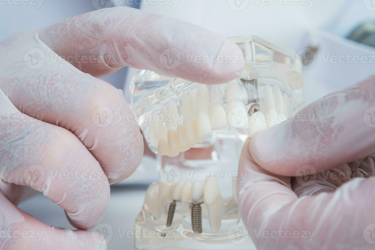 el ortodoncista sostiene un modelo de dientes con implantes en su mano y muestra cómo a insertar el diente. cerca arriba. macro foto