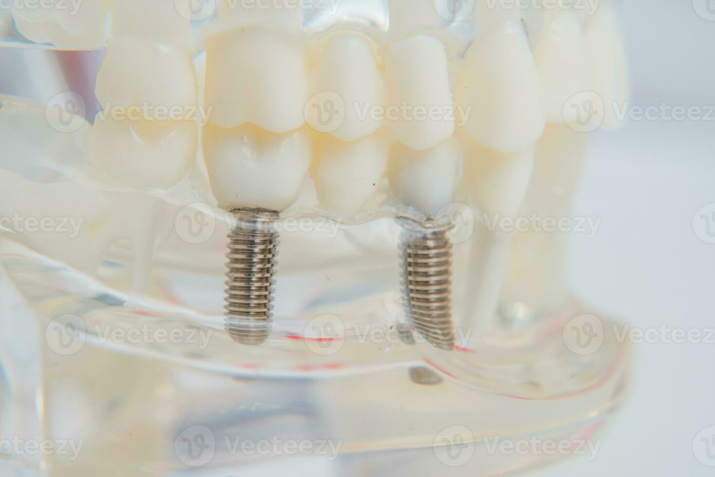 un modelo de dientes con implantes mentiras en un mesa foto