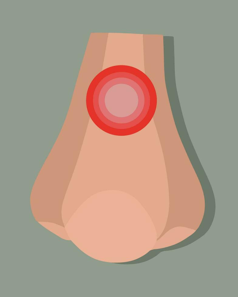 Vector isolated illustration of sinusitis. Runny nose. Nasal congestion.