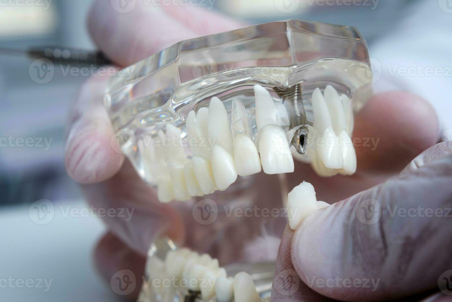 the orthodontist holds a model of teeth with implants in his hand and shows how to insert the tooth. Close up. Macro photo