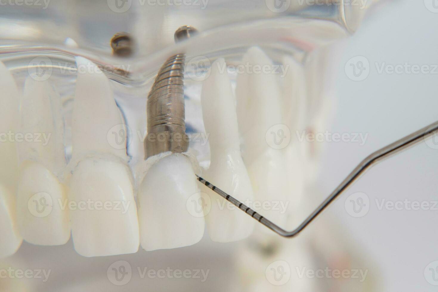 un modelo de dientes con implantes mentiras en un mesa foto