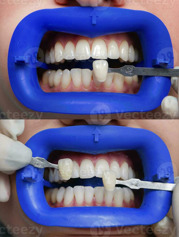 el procedimiento para comparando el color sombras de dientes antes de y después blanqueamiento foto