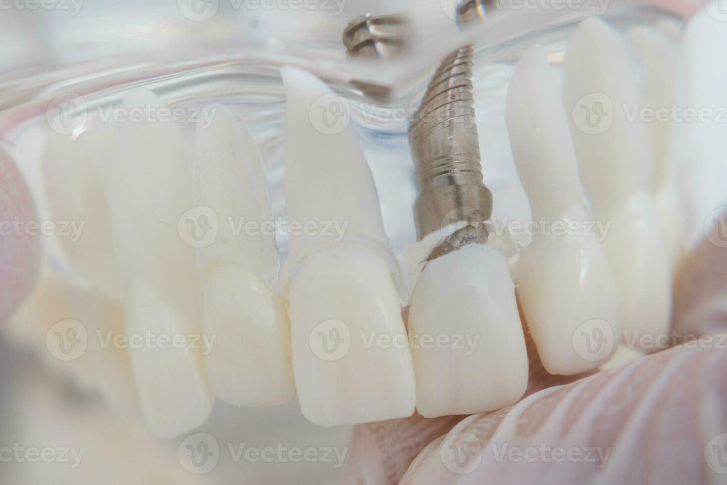 un modelo de dientes con implantes mentiras en un mesa foto